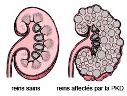 Healthy poly kidney fr